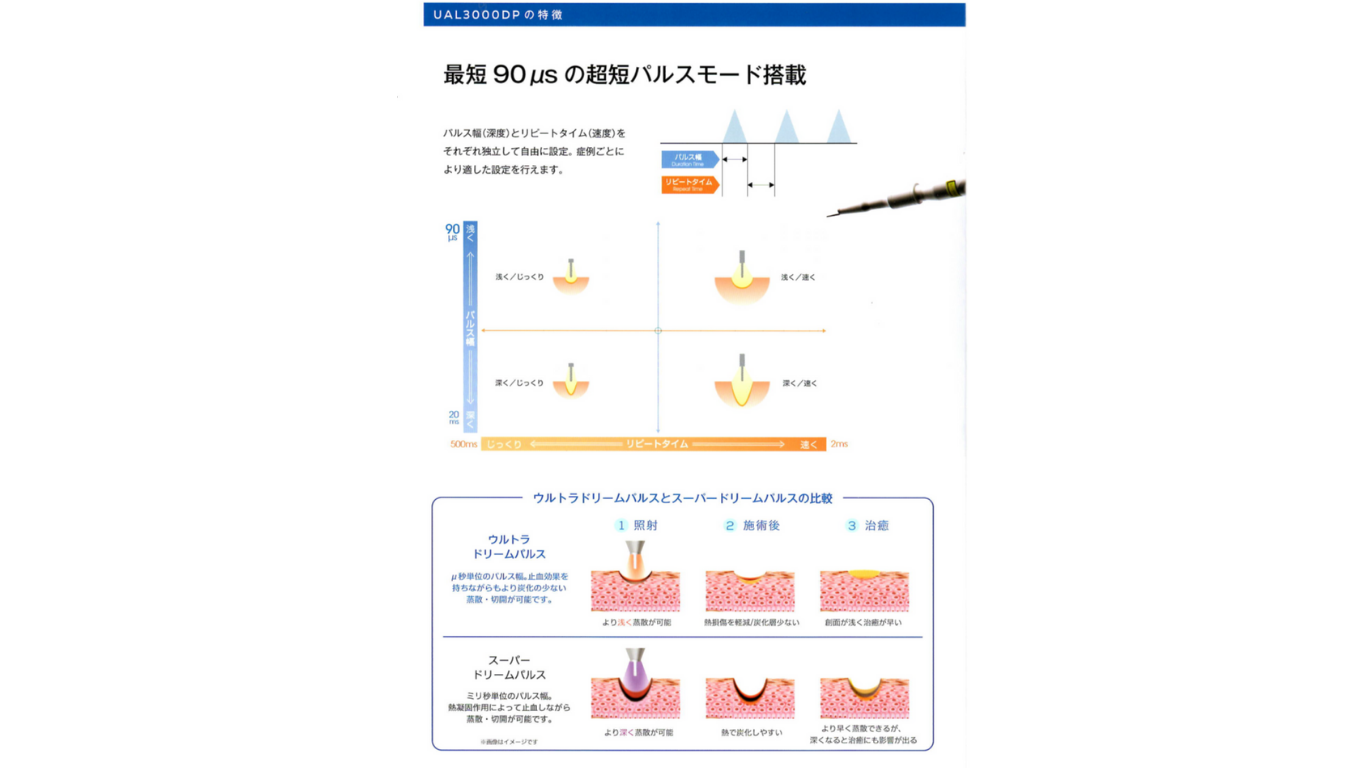 CO₂レーザー施術イメージ
